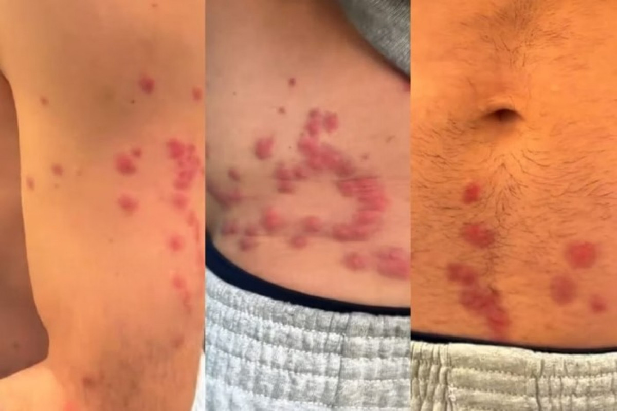 Em vídeo, Thiago mostrou manchas avermelhadas na região do abdômen, nos braços e nas pernas (Reprodução/Instagram) Em vídeo, Thiago mostrou manchas avermelhadas na região do abdômen, nos braços e nas pernas/Reprodução/Instagram