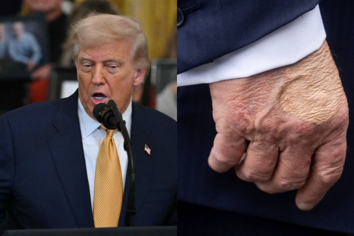 Fotos recentes mostram hematomas nas mãos de Trump (ANDREW CABALLERO-REYNOLDS / AFP e Jim WATSON / AFP) Fotos recentes mostram hematomas nas mãos de Trump/ANDREW CABALLERO-REYNOLDS / AFP e Jim WATSON / AFP