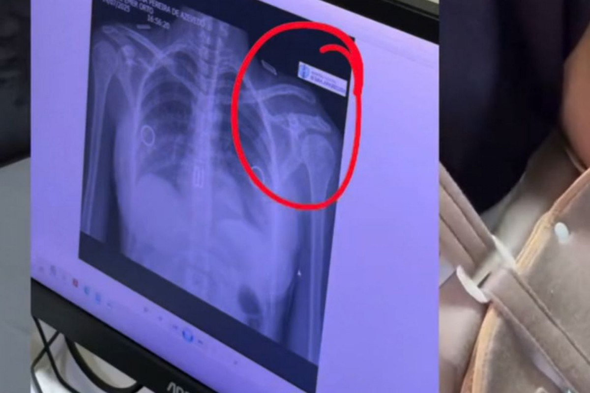 No vídeo, a influenciadora mostra como ficou a situação do ombro após o acidente, além das imagens de raio X.

