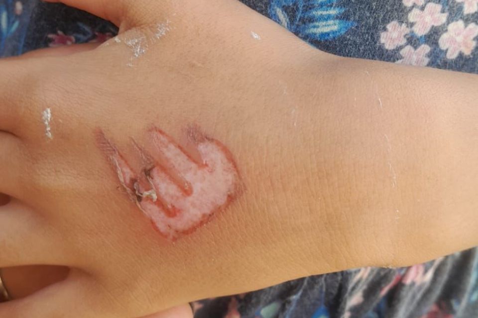 Mãe queima com fósforo a genitália da filha de 7 anos, em Olinda
(Conselho Tutelar) Mãe queima com fósforo a genitália da filha de 7 anos, em Olinda
/Conselho Tutelar