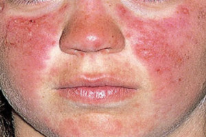 O Lúpus Eritematoso Sistêmico (LES ou apenas lúpus) é uma doença inflamatória crônica de origem autoimune