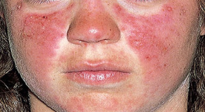 O Lúpus Eritematoso Sistêmico (LES ou apenas lúpus) é uma doença inflamatória crônica de origem autoimune/Reprodução/ MINISTÉRIO DA SAÚDE