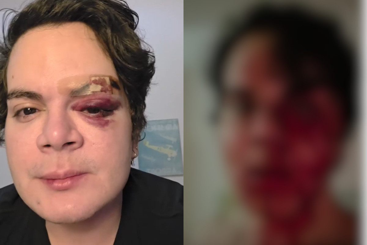 Médico Anderson Juliano de Lima com ferimentos no rosto após agressão de vizinho no Recife/Foto: Reprodução/Redes sociais