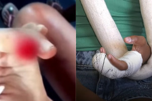 Menina foi salva por outro cachorro que passava pelo local e avan&ccedil;ou na cadela durante o ataque.