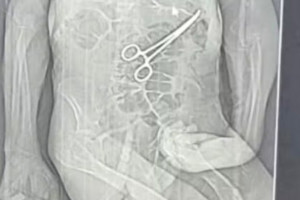 Tomografia mostrou pin&ccedil;a cir&uacute;rgica dentro do corpo do idoso