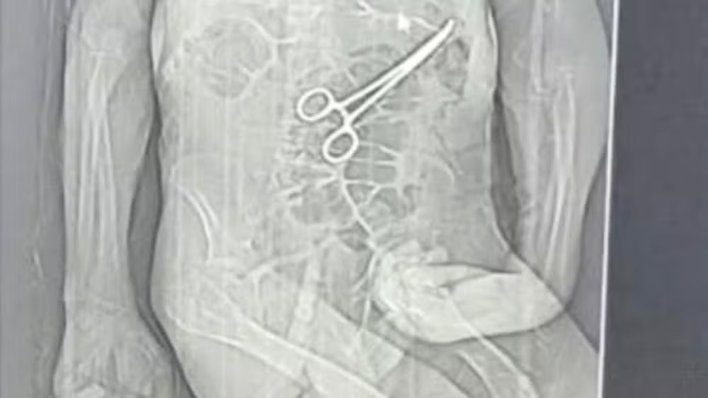 Tomografia mostrou pinça cirúrgica dentro do corpo do idoso/Foto: Rádio Nova FM/Reprodução