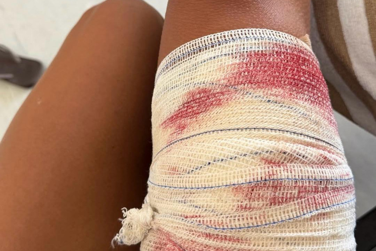 Turista mostrou curativo feito em hospital da ilha após mordida de tubarão/Foto: Reprodução/Instagram