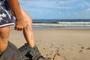 Cicatriz ap&oacute;s ataque de tubar&atilde;o em Olinda