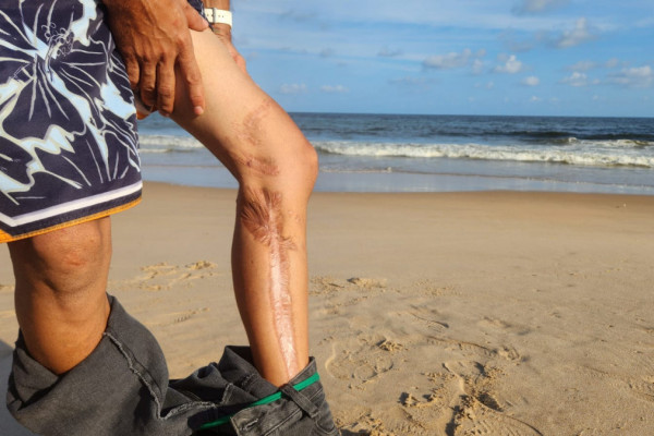 Cicatriz após ataque de tubarão em Olinda (Marília Parente/DP)