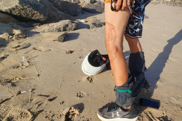 Cicatriz após ataque de tubarão em Olinda (Marília Parente/DP)