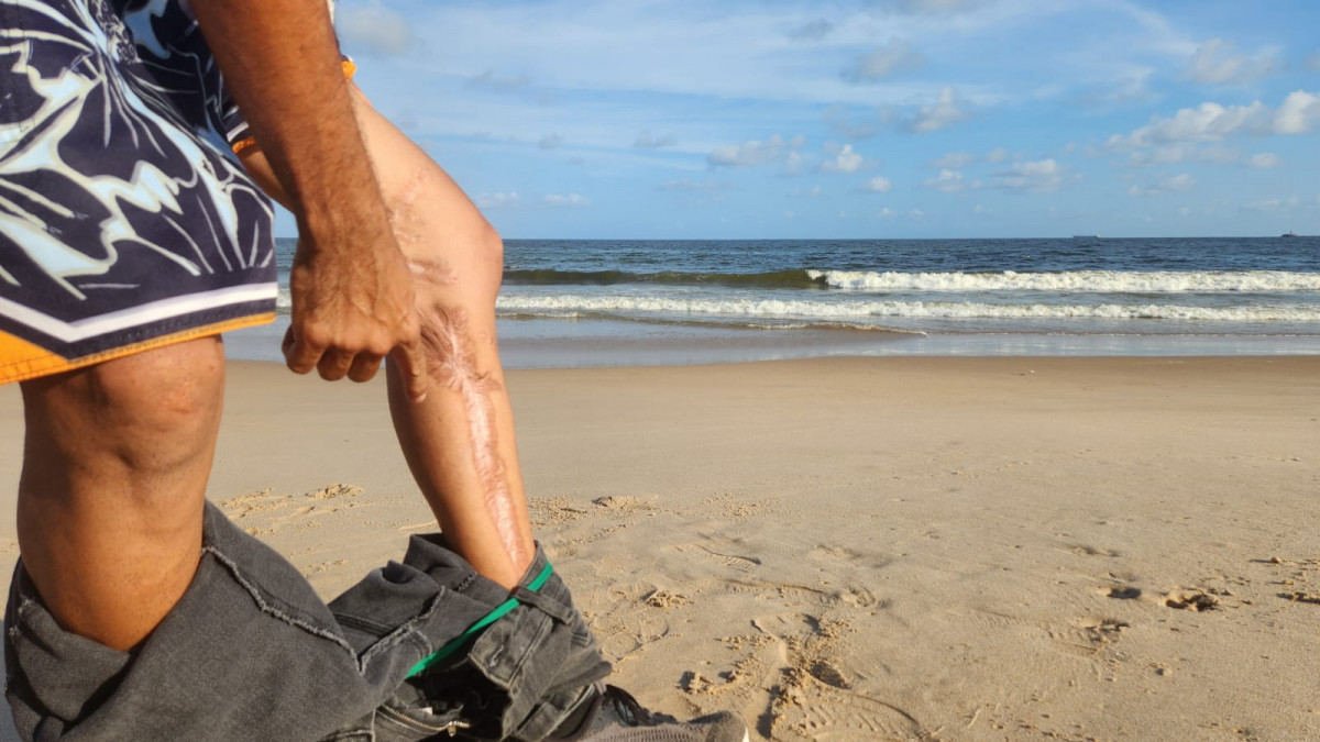 Cicatriz após ataque de tubarão em Olinda/Marília Parente/DP
