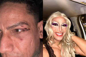 Augusto foi agredido no rosto no carnaval de Olinda 