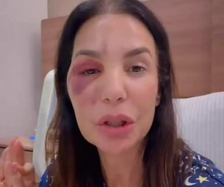 Ivete Sangalo após cirurgia /Reprodução/Redes sociais