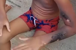 Menino de 6 anos sofre queimaduras ap&oacute;s explos&atilde;o de celular no Recife