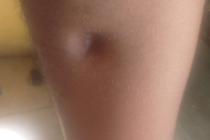 Segundo advogada, jovem tem sequelas e sente dores na perna atingida.