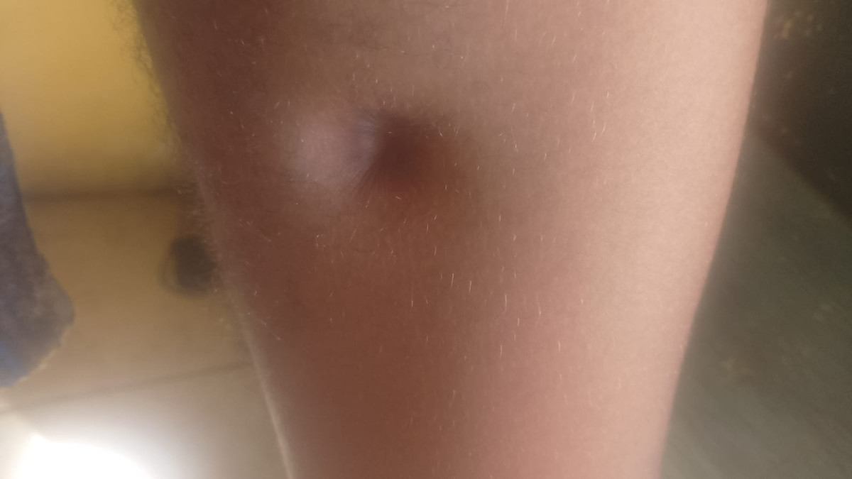 Segundo advogada, jovem tem sequelas e sente dores na perna atingida./Foto: Cortesia