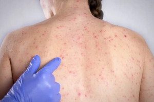 O sarampo &eacute; uma doen&ccedil;a infecciosa altamente transmiss&iacute;vel, cuja preven&ccedil;&atilde;o depende, fundamentalmente, da vacina&ccedil;&atilde;o