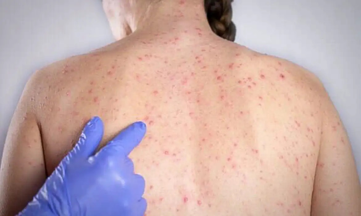 O sarampo é uma doença infecciosa altamente transmissível, cuja prevenção depende, fundamentalmente, da vacinação/DIVULGAÇÃO/ANAMAT