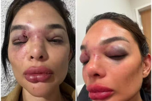 Dentista Giulia Falc&atilde;o foi agredida com socos no rosto e no corpo