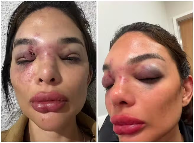 Dentista Giulia Falcão foi agredida com socos no rosto e no corpo/Reprodução/Redes Sociais