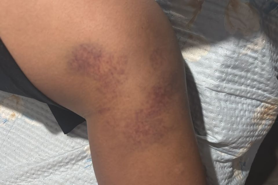 Adolescente de 13 anos é agredido em escola municipal de Jaboatão e passa por cirurgia nesta quarta-feira (16), no Recife /Cortesia
