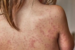 No Brasil, at&eacute; de outubro, foram registrados 52 casos importados em SP, no AM no RJ