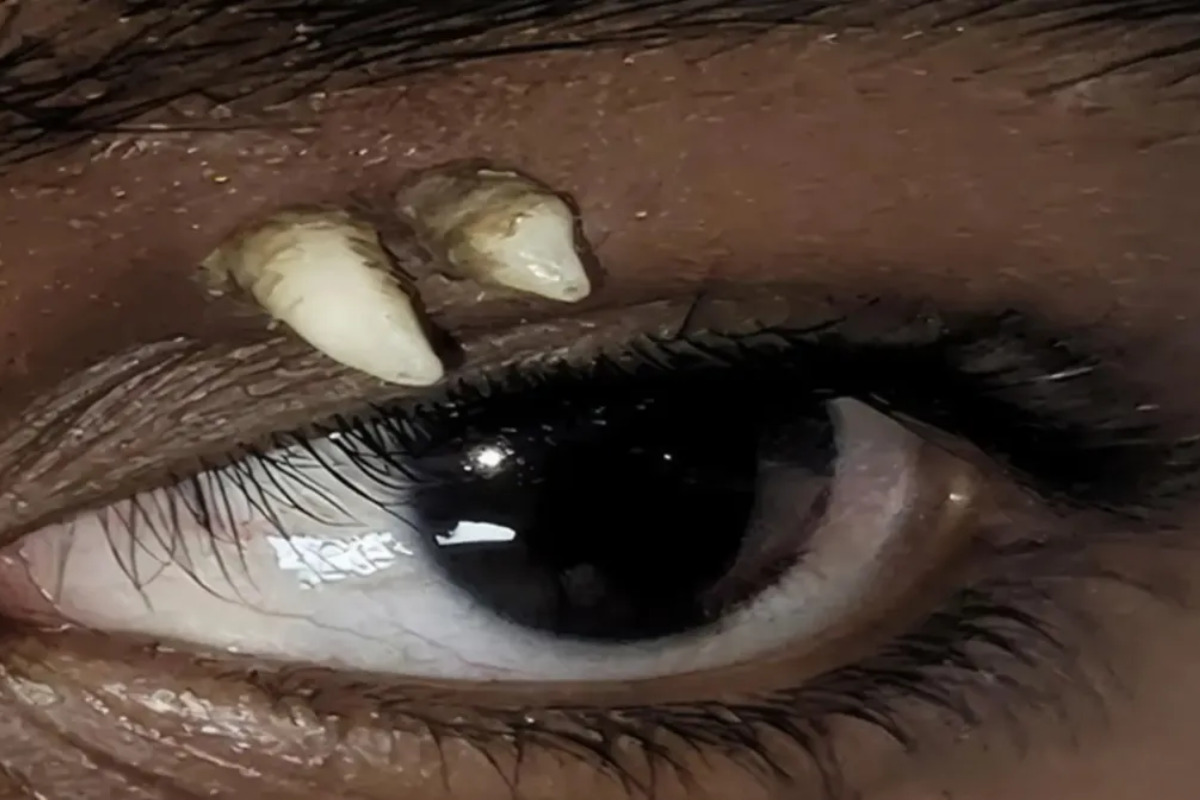 Adolescente de 16 anos retira dente encontrado na regi&atilde;o do olho na &Iacute;ndia - Divulga&ccedil;&atilde;o