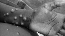 Mais de 200 casos confirmados de varíola do macaco no mundo, segundo agência europeia (Foto: OMS/ Centro de Controle de Doenças da Nigéria
)