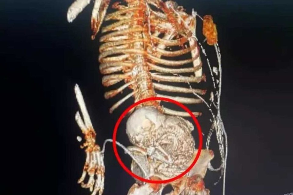 
Feto estava calcificado h mais de 50 anos (foto: Reproduo)