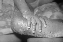 Primeiro caso de varíola dos macacos é confirmado em Minas Gerais (crédito: Reprodução/CDC)