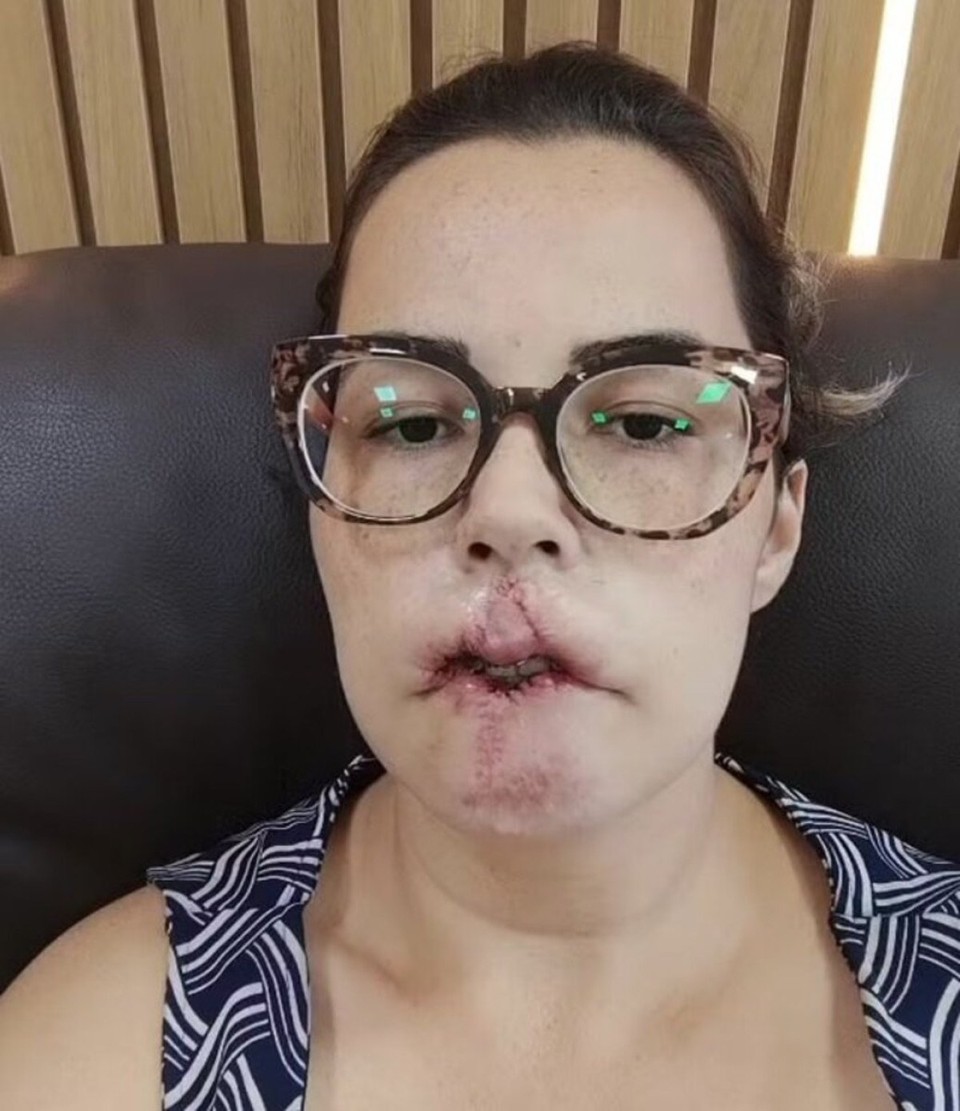 Seis meses depois do procedimento, Mariana acordou com o rosto muito inchado e dolorido (foto: Redes Sociais/ Reprodução)