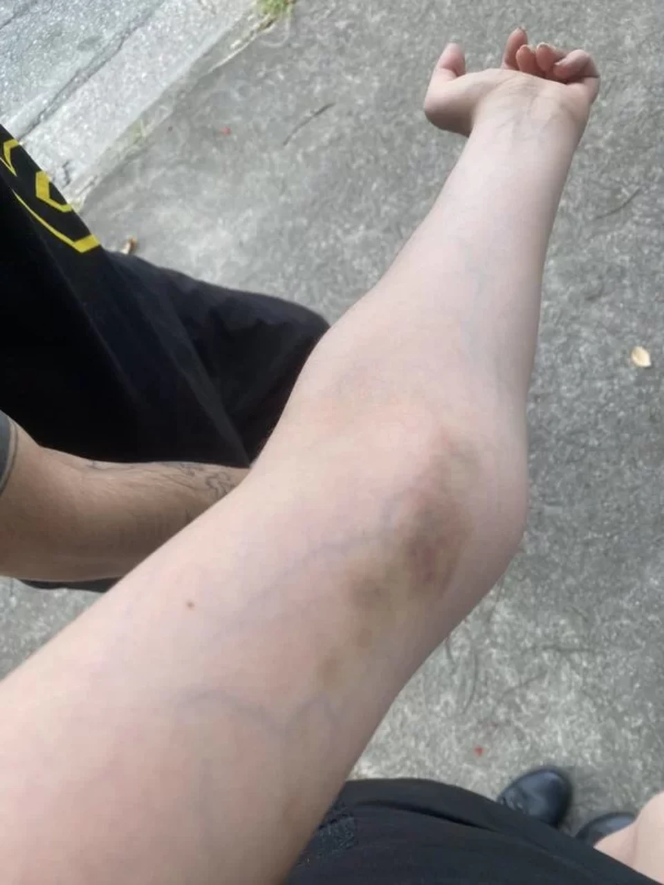 Hematoma no brao da atriz (Crdito: Reproduo)