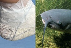 Banhista passa 4 horas com espinho preso no p aps pisar em peixe bagre em Boa Viagem (Fotos: Cortesia e Pixabay)