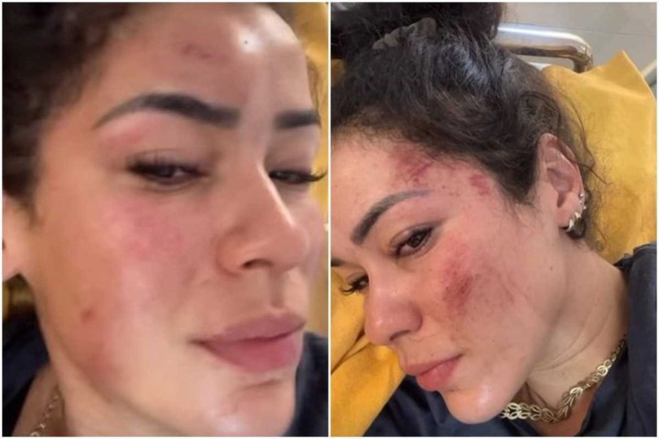 "Meu rosto est assim, mas no  o que mais me di. Achei que amos morrer. Graas a Deus estamos vivos", disse a brasileira violentada na ndia (Foto: Reproduo)