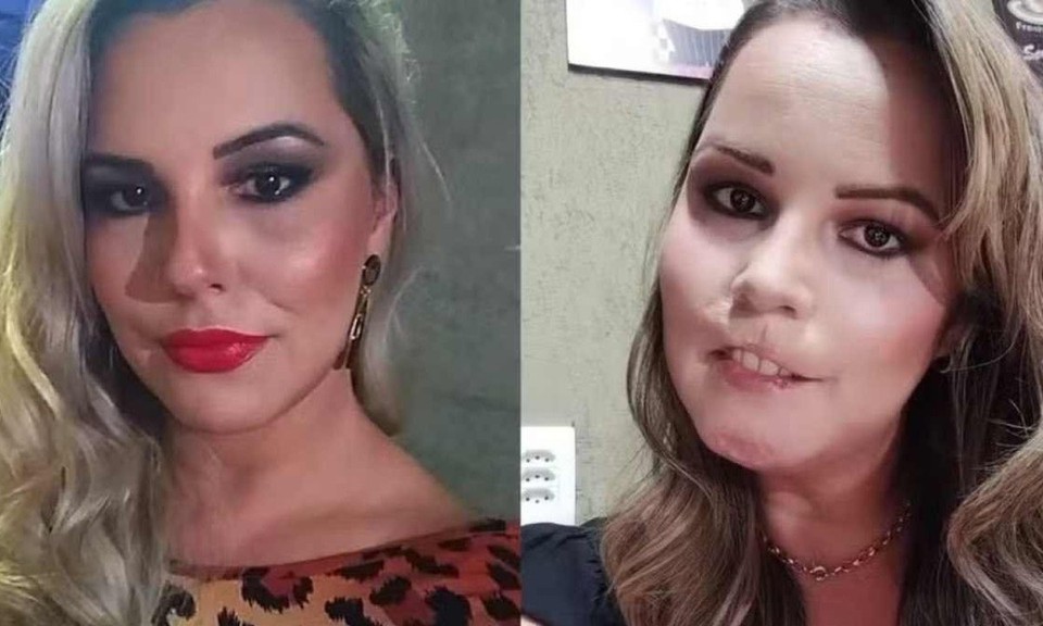 Depois de voltar na profissional que realizou o preenchimento, Mariana recorreu a uma consulta com uma dermatologista que receitou um tratamento com antibióticos e corticoides, que não tiveram efeito (foto: Redes Sociais/ Reprodução)
