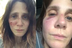 Atriz francesa Judith Chemla mostra feridas de violência doméstica (crédito: Reprodução/Instagram @judithhhhhhhhhhhhhh)