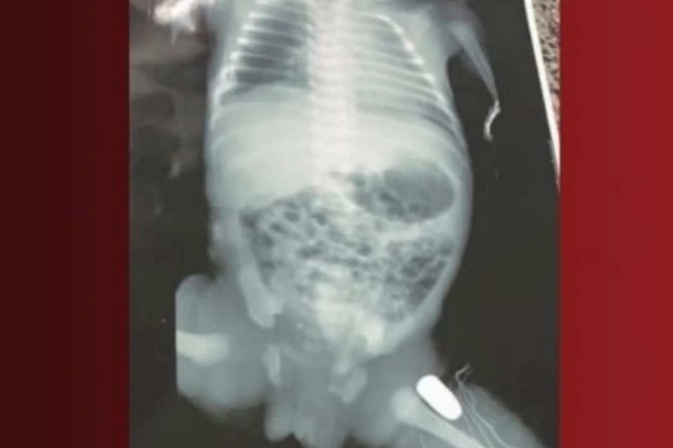 A cirurgia na beb foi realizada aps a me ser submetida a uma cesrea (Crdito: Reproduo/Bom dia)