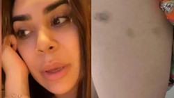 Naiara Azevedo anexou imagens de vrios hematomas pelo corpo