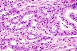 Técnica reverte agressividade do câncer de pâncreas (Foto: KGH/Divulgação)