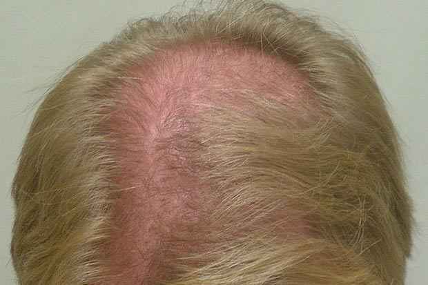  possvel reverter a queda de cabelo na maioria dos casos. Foto:Evolution Hair Centers/Flickr/Reproduo