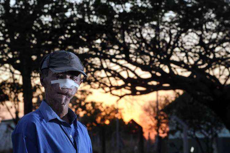  Jos Cludio Machado tem xeroderma pigmentoso, uma doena gentica que atinge moradores de povoado de Faina. Foto: Ronaldo de Oliveira/CB/D.A Press