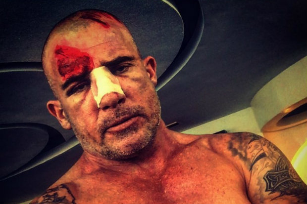 Ator postou uma foto com o rosto machucado. Foto: Instagram/Reproduo