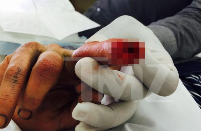 Imagem da ferida foi divulgada sem tarja pelo site norte-americano. Foto: TMZ/Reproduo