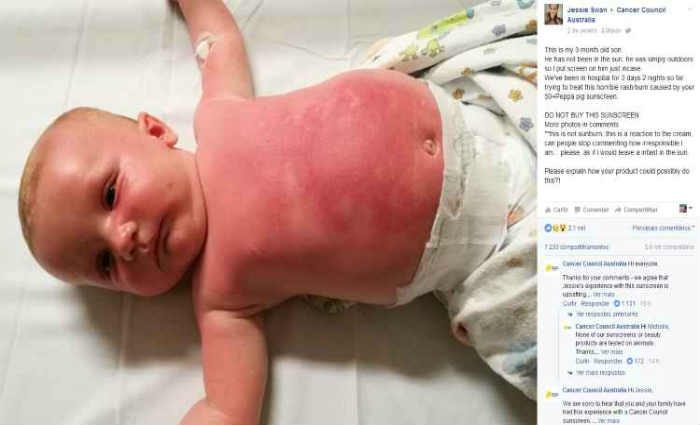 
Jessie postou uma foto do beb com manchas avermelhadas no trax, nos braos e no rosto. Foto: Cancer Council Australia/Facebook
