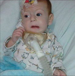 Matheus Blum nasceu prematuro. Desde o vigsimo dia de vida, precisa utilizar aparelho respiratrio e sonda para se alimentar. Foto: Instagram/Reproduo