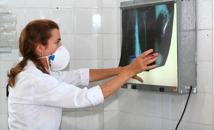 Levantamento destaca a necessidade de os governos aumentarem os esforços de combate à tuberculose que, em 2015, matou 1,8 milhão de pessoas no mundo. Foto: Agecom Bahia Levantamento destaca a necessidade de os governos aumentarem os esforços de combate à tuberculose que, em 2015, matou 1,8 milhão de pessoas no mundo. Foto: Agecom Bahia