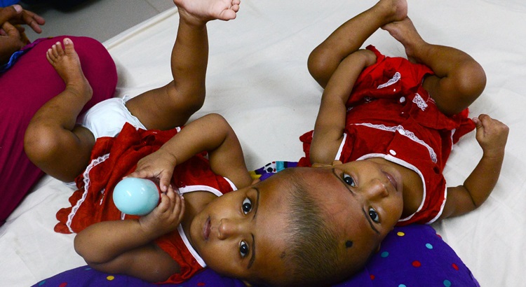 Em casos raros, gmeos idnticos podem nascer com a pele e com certos rgos internos ligados. Foto: Munir Uz Zaman/AFP
