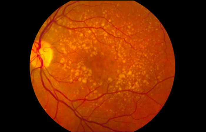 Foto: National Eye Institute of the NIH / Creative Commons Foto: National Eye Institute of the NIH / Creative Commons
