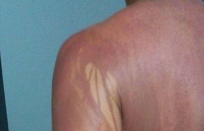 Segundo boletim mdico do Hospital Regional Costa do Cacau, inicialmente ele teria sofrido queimaduras de primeiro grau, com quadro de escamao (Foto: Arquivo Pessoal )