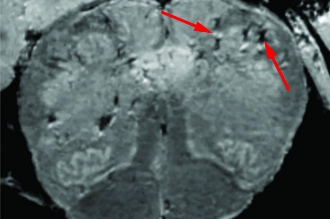 (Pontos claros e escuros marcados pelas setas demonstram os danos cerebrais em pacientes com Covid-19. Foto: NIH/NINDS/Divulgao)